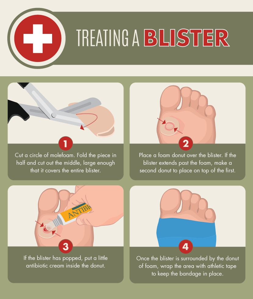 How to Treat a Blister